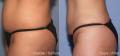 Liposuctie cu laser